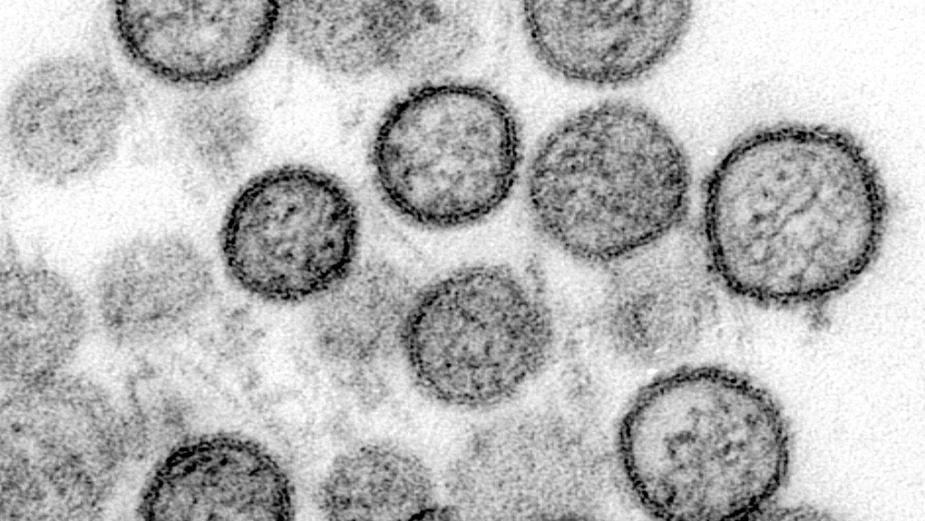 Una persona fallece por hantavirus en medio de la pandemia por el COVID-19.