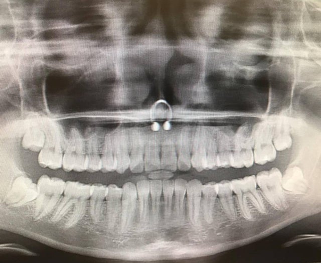 19. Me hice un panorámica dental y se me olvidó quitarme el piercing.